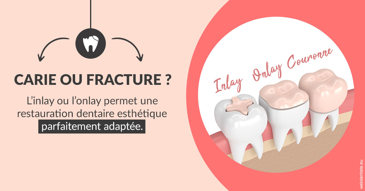 https://selarl-emile-roux.chirurgiens-dentistes.fr/T2 2023 - Carie ou fracture 2