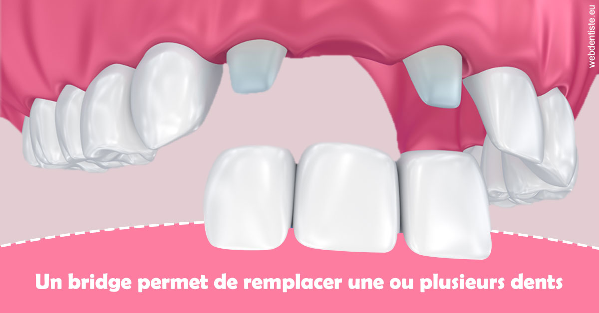 https://selarl-emile-roux.chirurgiens-dentistes.fr/Bridge remplacer dents 2