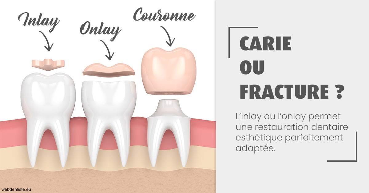 https://selarl-emile-roux.chirurgiens-dentistes.fr/T2 2023 - Carie ou fracture 1