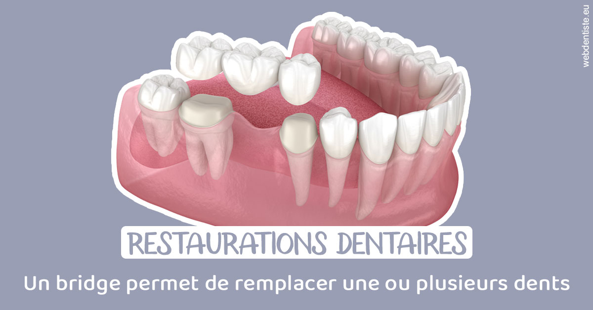 https://selarl-emile-roux.chirurgiens-dentistes.fr/Bridge remplacer dents 1