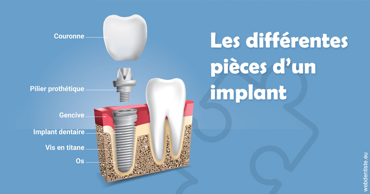 https://selarl-emile-roux.chirurgiens-dentistes.fr/Les différentes pièces d’un implant 1